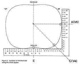 Figure 2. Location of V6 Electrode using the Chest Square 6.3.6