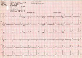 Figure 4. Typical Electrocardiogram Using the MAC PC